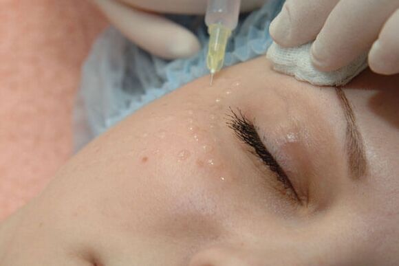 Mezoterápia - az arcbőr fiatalításának injekciós módszere