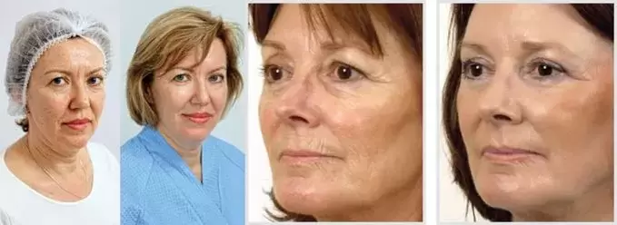 A lézeres arcbőrfiatalítás eredménye a ráncok csökkentése