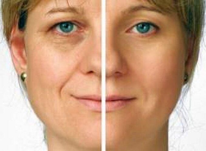 bőr a szem körül a fiatalítás előtt és után